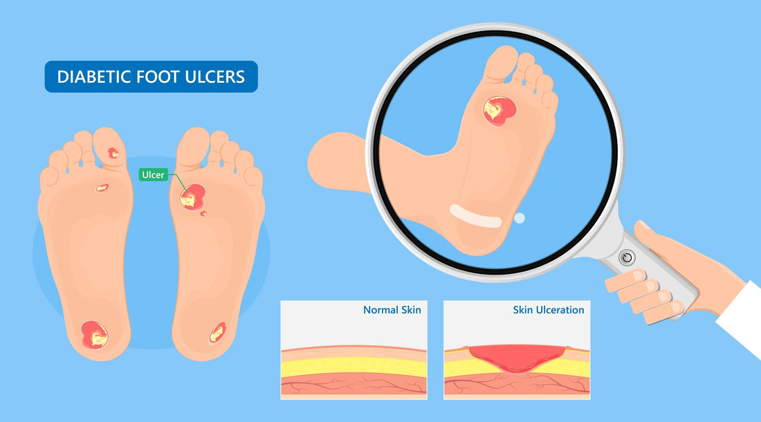 Diabetic Ulcers