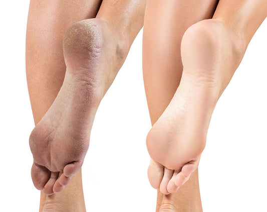 Calluses On Feet