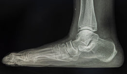Flat Feet Treatment