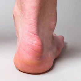 Haglunds Deformity Treatment