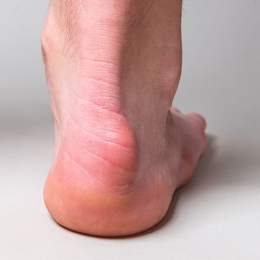 Haglunds Deformity Treatment