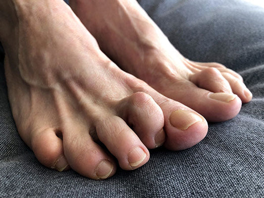 What Are Hammer Toes?