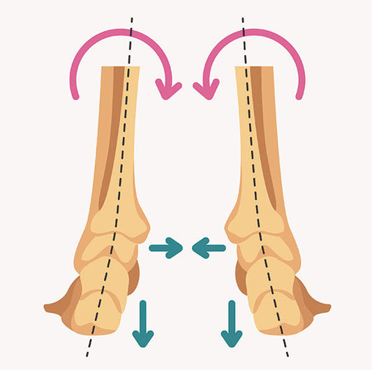 Foot Overpronation