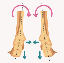 Foot Overpronation