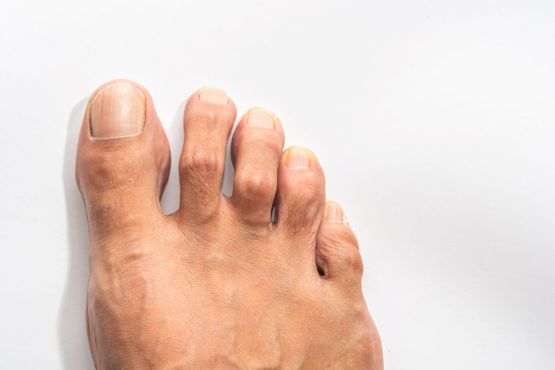 What is Claw Toe?
