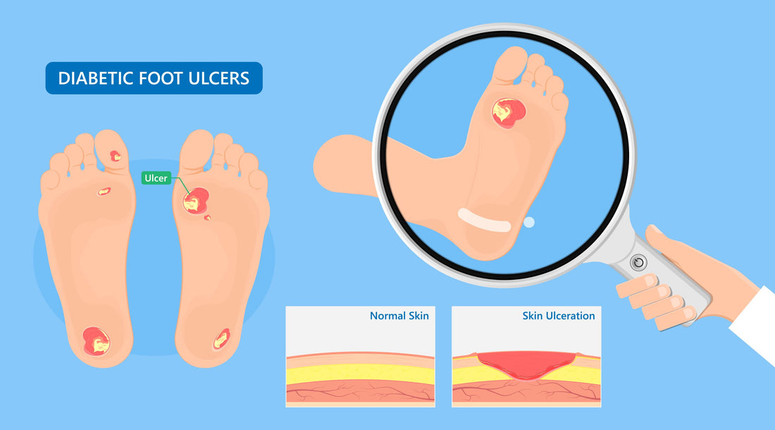 Diabetic Ulcers