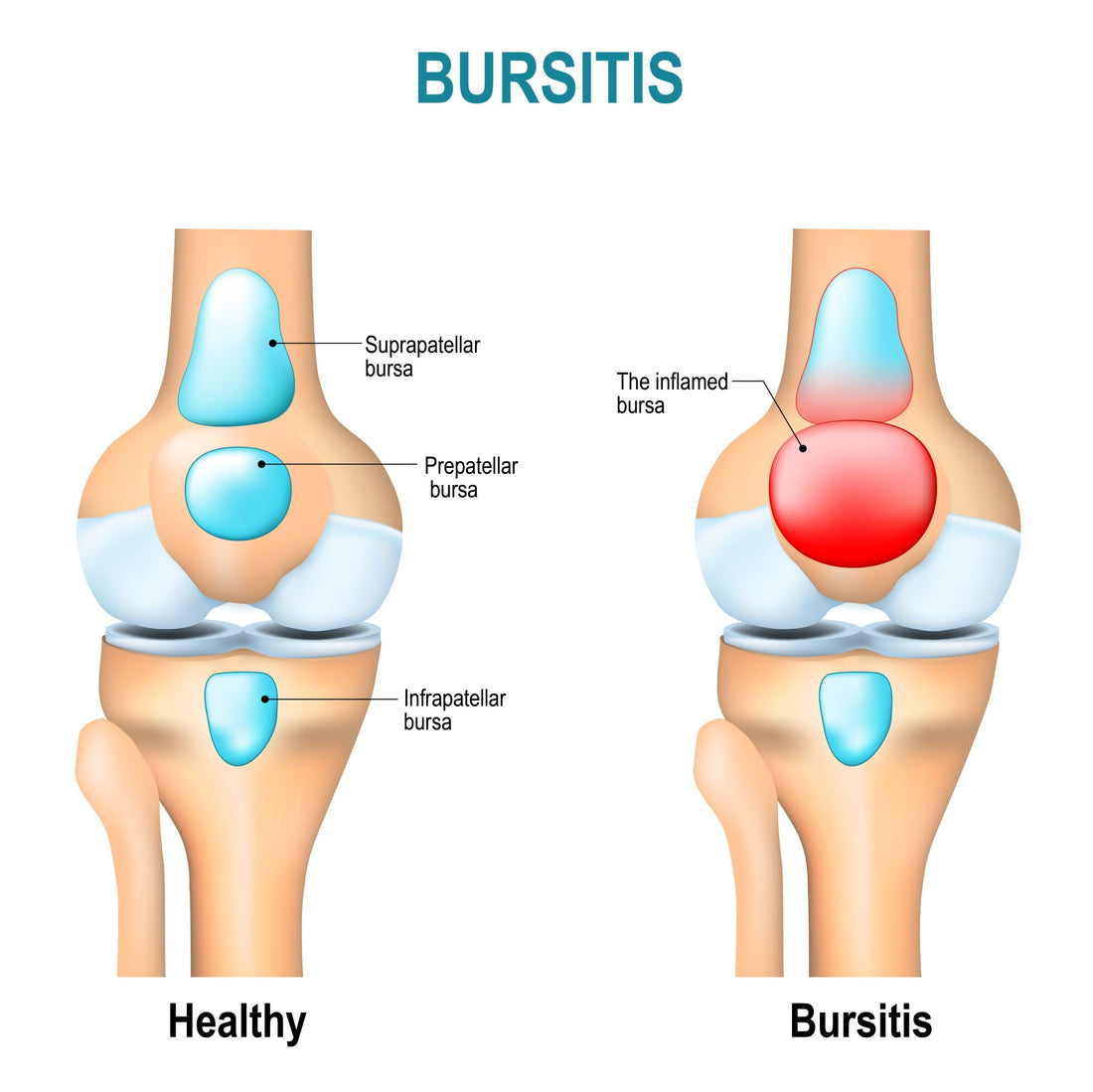 Prepatellar Bursitis