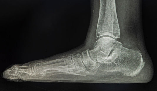 Flat Feet Treatment