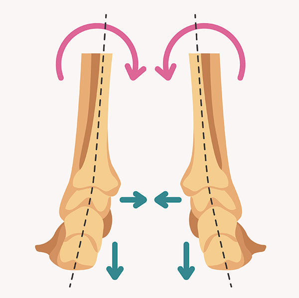 Foot Overpronation