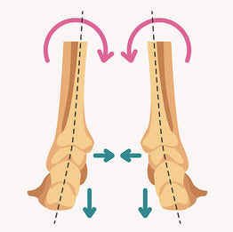 Foot Overpronation