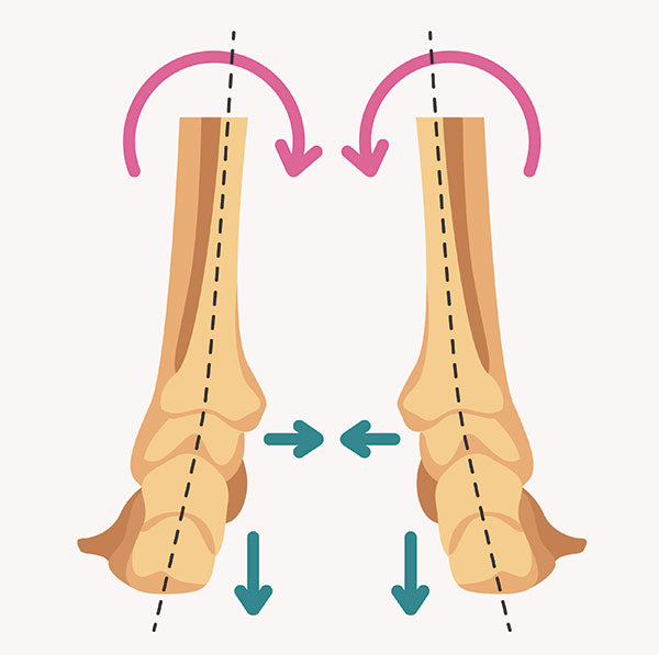Foot Overpronation