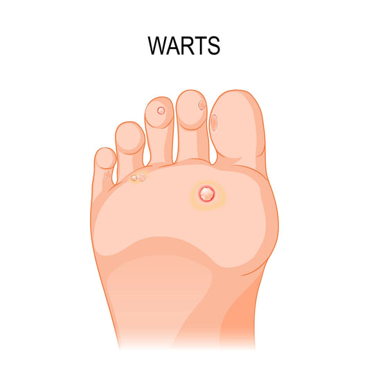 Plantar Warts