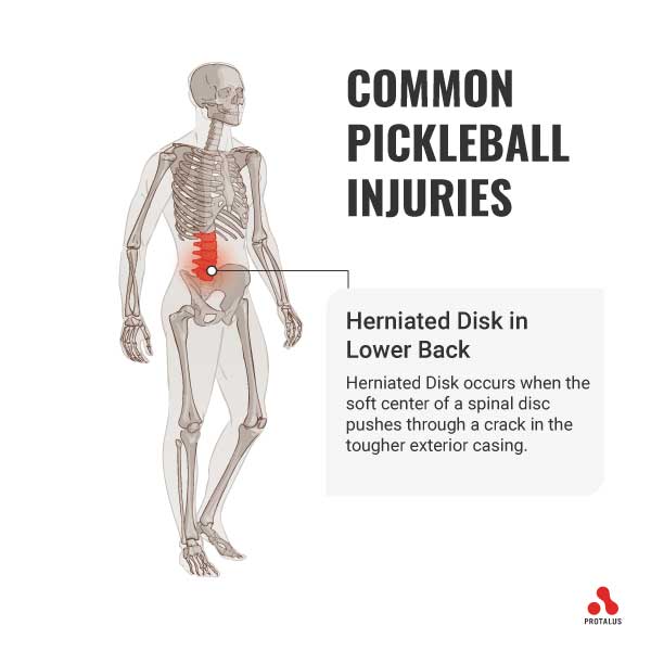 Herniated Disk