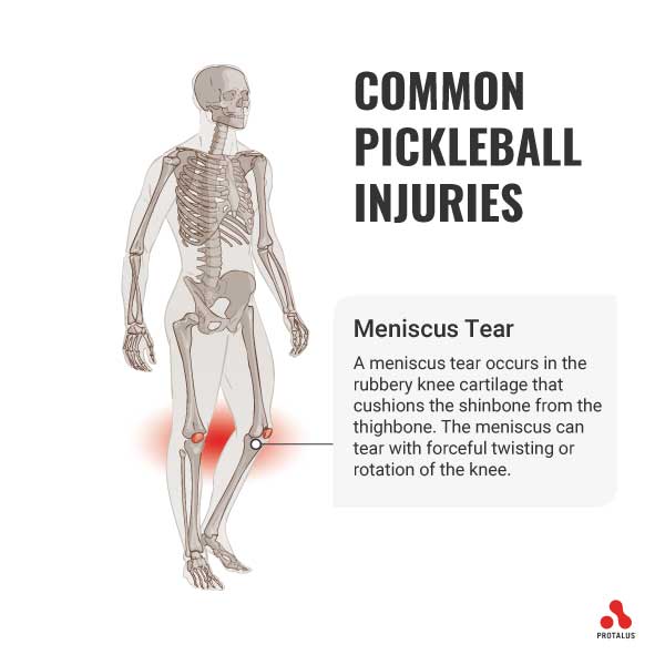 Meniscus Tear