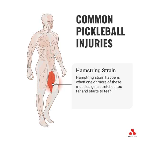 Hamstring Strain